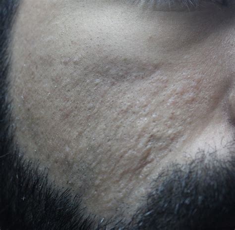 Help Are These Whiteheads General Acne Discussion Forum