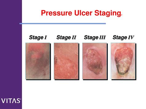 Stage Pressure Ulcer Wounds