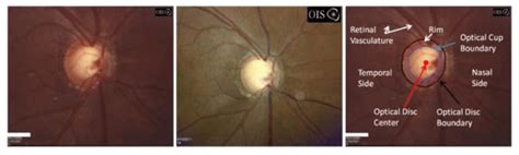 A Glaucomatous Patient With Progressed Optic Nerve Cupping As Shown By