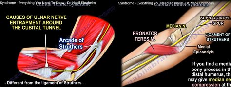 Cubital Tunnel Syndrome —