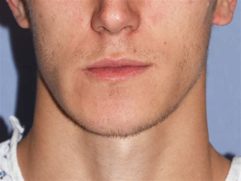 Plastic Surgery Case Study Long Term Outcome In Male Intraoral