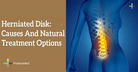 Back pain is something a very large number of people have to deal with at one point or another. Herniated Disk: Causes and Natural Treatment Options - PositiveMed
