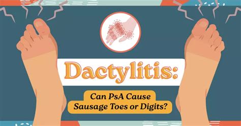 Dactylitis Can Psa Cause Sausage Toes Or Digits Mypsoriasisteam