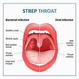 Strep Throat Symptoms & Causes | Latest Treatment at Medicover