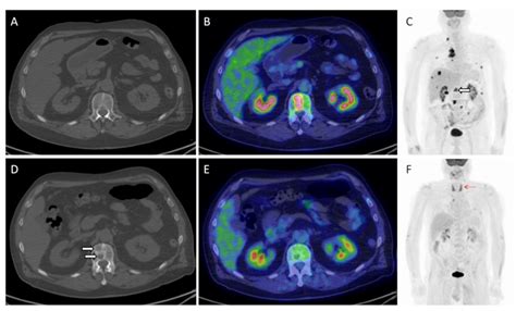 Jcm Free Full Text Immunotherapy Monitoring With Immune Checkpoint