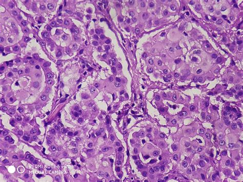 Search a wide range of information from across the web with searchonlineinfo.com. EPITHELIAL MALIGNANT MESOTHELIOMA - Histopathology.guru