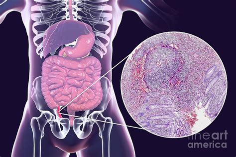 Chronic Appendicitis Photograph By Kateryna Konscience Photo Library