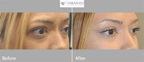 How to treat thyroid eye disease (ted). Graves Disease - Thyroid Eye Disease (Orbital ...