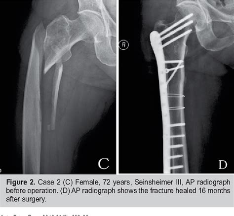 Figure 2 From Treatment Of Femoral Subtrochanteric Fractures With