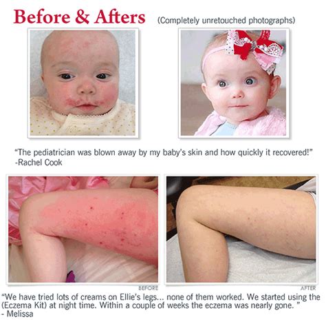 Eczema Experts Hydrocortisone Barrier Cream Cheryl Lee Md Sensitive
