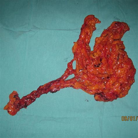 Intraoperative Intra Abdominal View Of The Flap Based On The Right