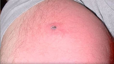 Brown Recluse Spider Bite Or Staph Infection Youtube
