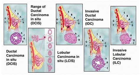 Invasive Ductal Carcinoma Gross