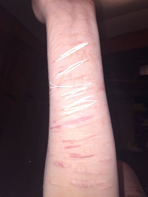 Scars On Left Arm Marked Out The Recent Ones Selfharmscars