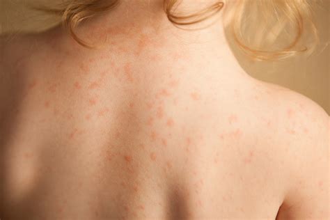 Heat Rash Treatment Rash Under The Breast Causes And When To See A Doctor Cooper Noriega Death