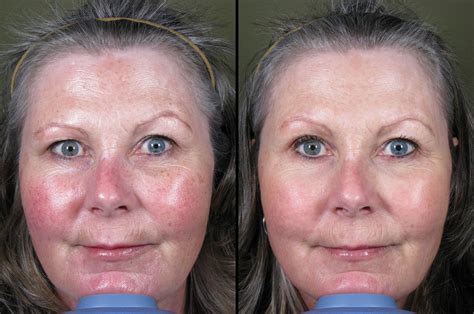 Laser For Facial Redness 2 Md Esthetics