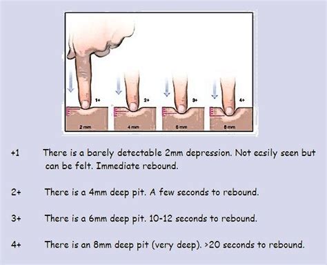 Pitting Edema Grading Nursing Pinterest Nclex Nursing Students