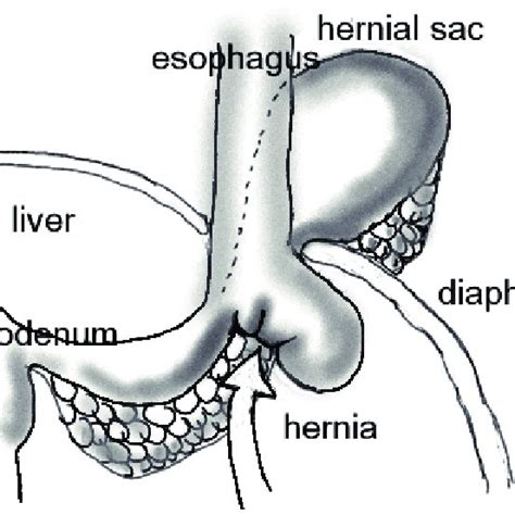 Normal Anatomy Of The Esophageal Hiatus Shown With Examples Of