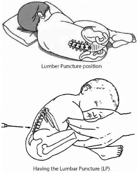 Lumbar Puncture Baby