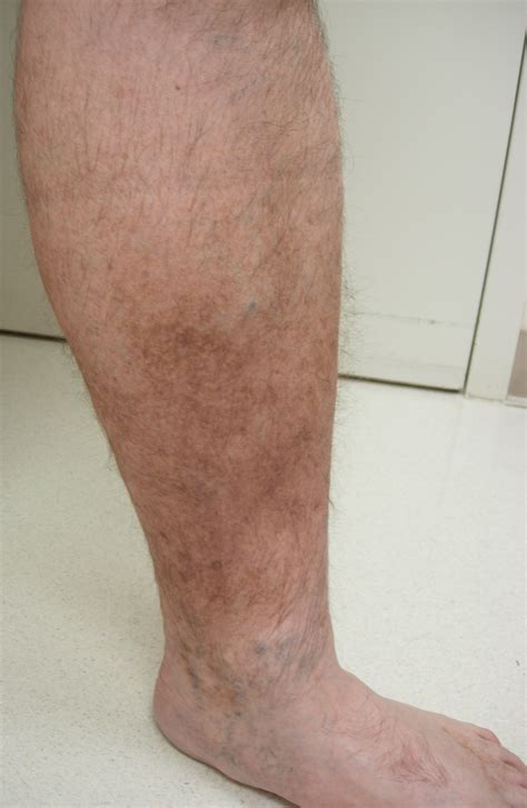 Leg Swelling Potential Health Hazard And Sign Of Venous Insufficiency