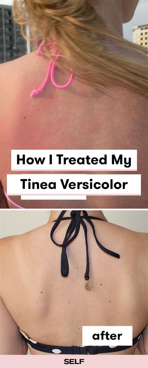 Tinea Versicolor Treatment Before And After