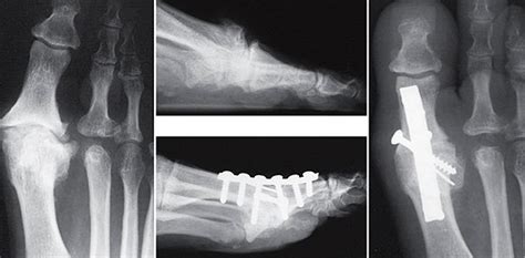 Hallux Limitus Rigidus Surgery Dr Alice Wang