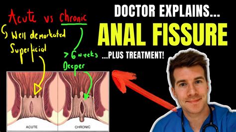 Doctor Explains Anal Fissure Including Causes Classification And Treatment Options Youtube