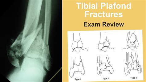 Tibial Plafond Fractures Exam Review Brian Weatherford Md Youtube
