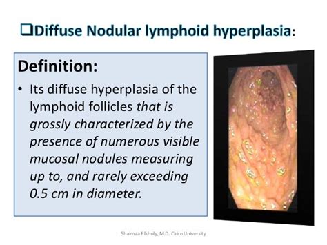 Diffuse Nodular Lymphoid Hyperplasia Dnlh