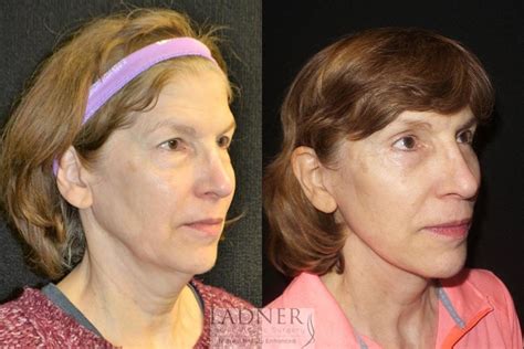 Facelift Neck Lift Before And After Pictures Case 33 Denver Co