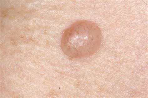 Intradermal Mole Naevus On Skin Stock Image C0041226 Science