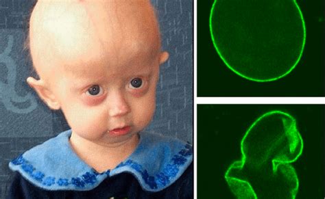 Progeria Syndrome Facts Causes Symptoms Life Expectancy Otosection