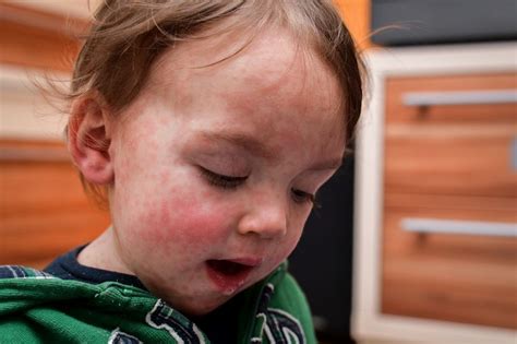 Hse Warn Of Measles Symptoms And Risks As Worrying Drop In Childrens
