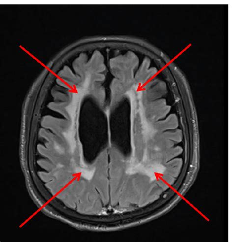 Signs Of Cerebral Small Vessel Disease Magnetic Resonance Imaging