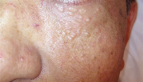 Derm Dx Skin Colored Papules On The Lower Eyelids Clinical Advisor