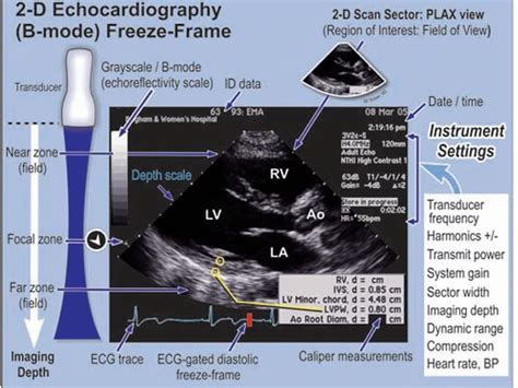 Pin By Andres Sanchez On Echocardiography Diagnostic Medical