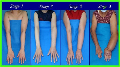 Best Treatment For Lymphedema How To Treat Lymphedema Naturally At