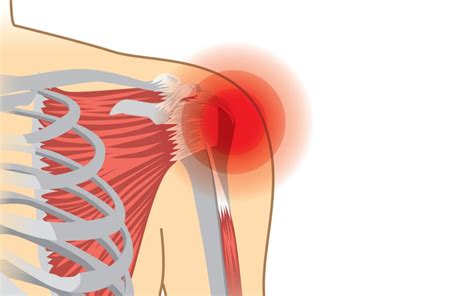 Physiotherapy helps you learn how to lift and carry objects and do other activities using the muscle groups that aren't hurt. How a Torn Rotator Cuff is Repaired - High Mountain ...