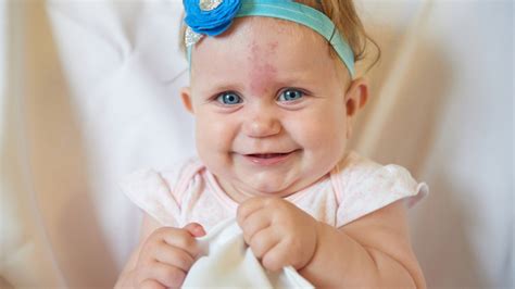 Understanding Birthmarks Types And Causes Diagnosis And Treatment