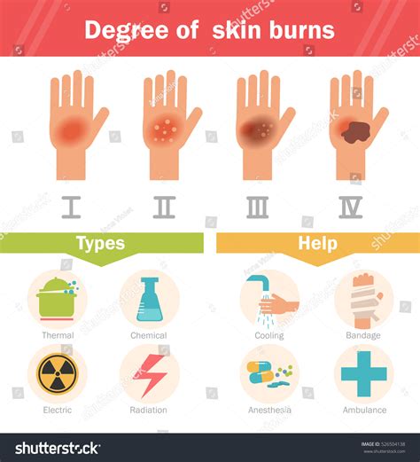 Degree Of Skin Burns Vector Cartoon Isolated Royalty Free Stock