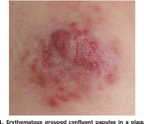 Pdf Erythematous Grouped Papules And Plaque On An Intra Articular