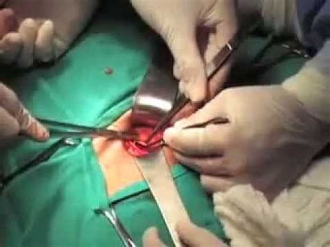 Direct inguinal hernia repair surgical video - YouTube