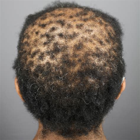 Central Centrifugal Cicatricial Alopecia