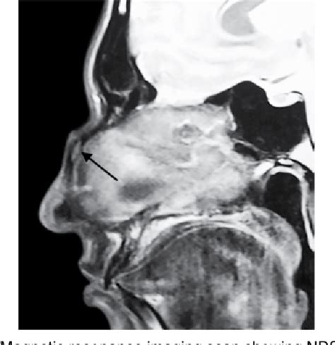 Figure 1 From Management Of Nasal Dermoid Sinus Cyst By Modified