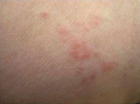 Picture Of Flea Bites On Humans Expert Tips