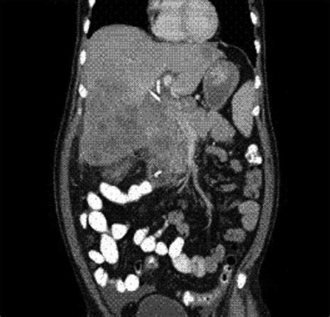 Ct Abdomen Coronal Section Showing A Large Caudate Lo Open I