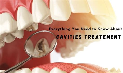 All That You Must Know About Cavities Treatment