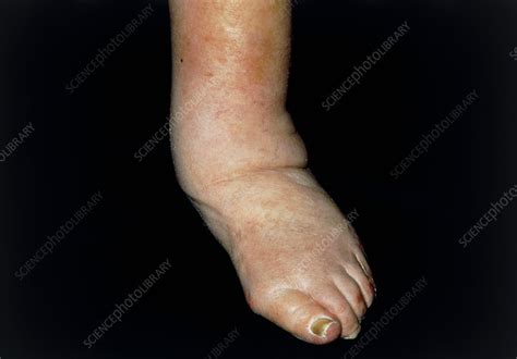 Deformed Ankle And Foot With Oedema Stock Image M2300148 Science