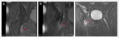 Figure 1 From Spontaneous Iliopsoas Tendon Tear Semantic Scholar