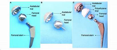 Hip Implants Types Metal Head Mom Total